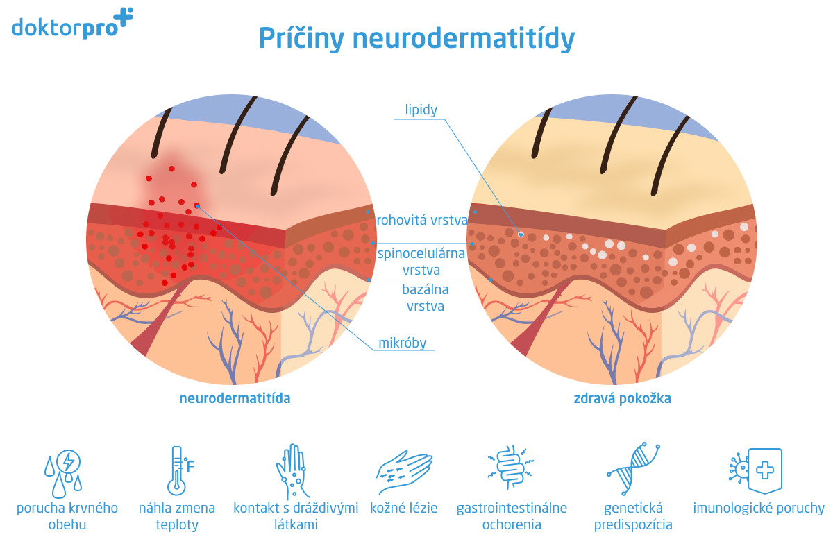 Príčiny neurodermatitídy