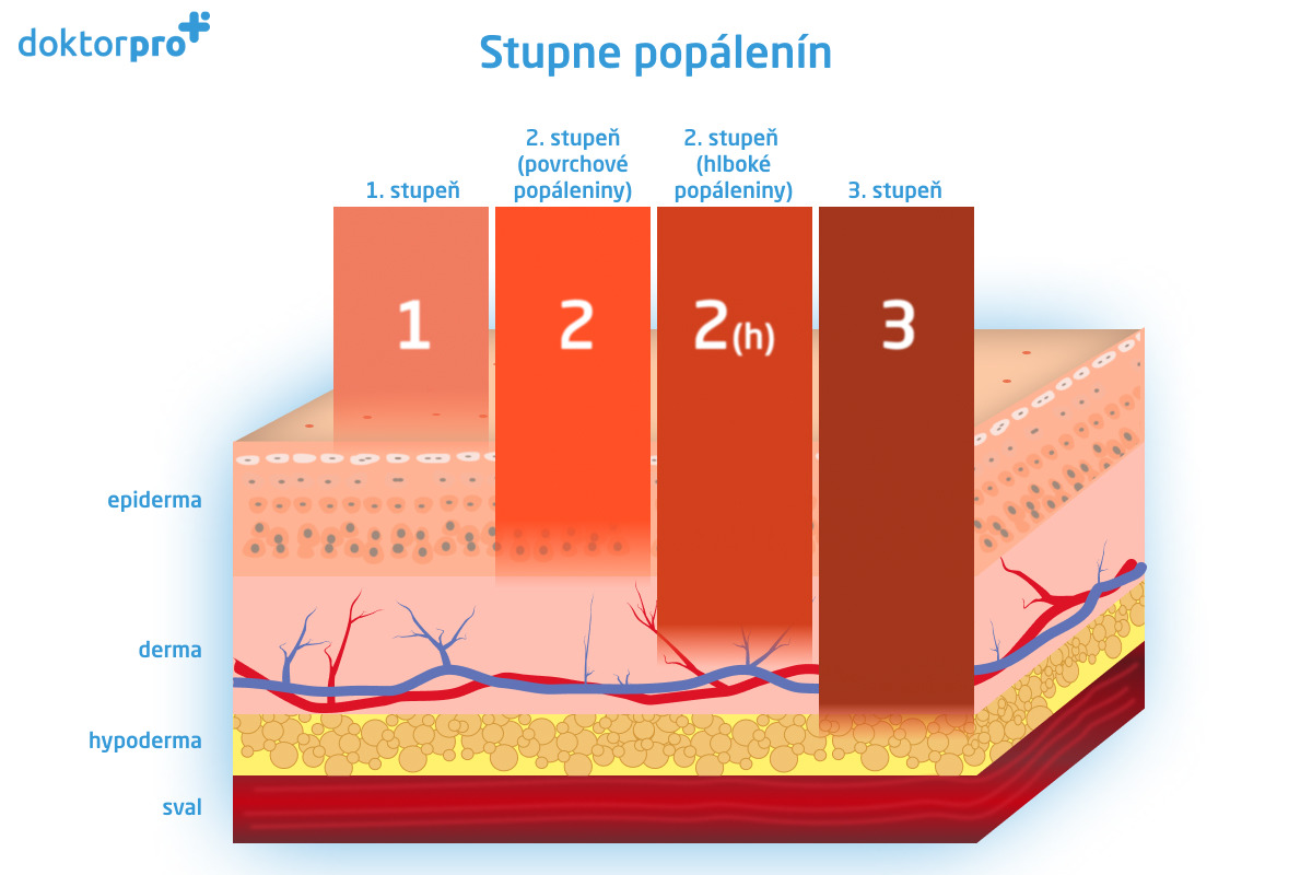 Stupne popálenín