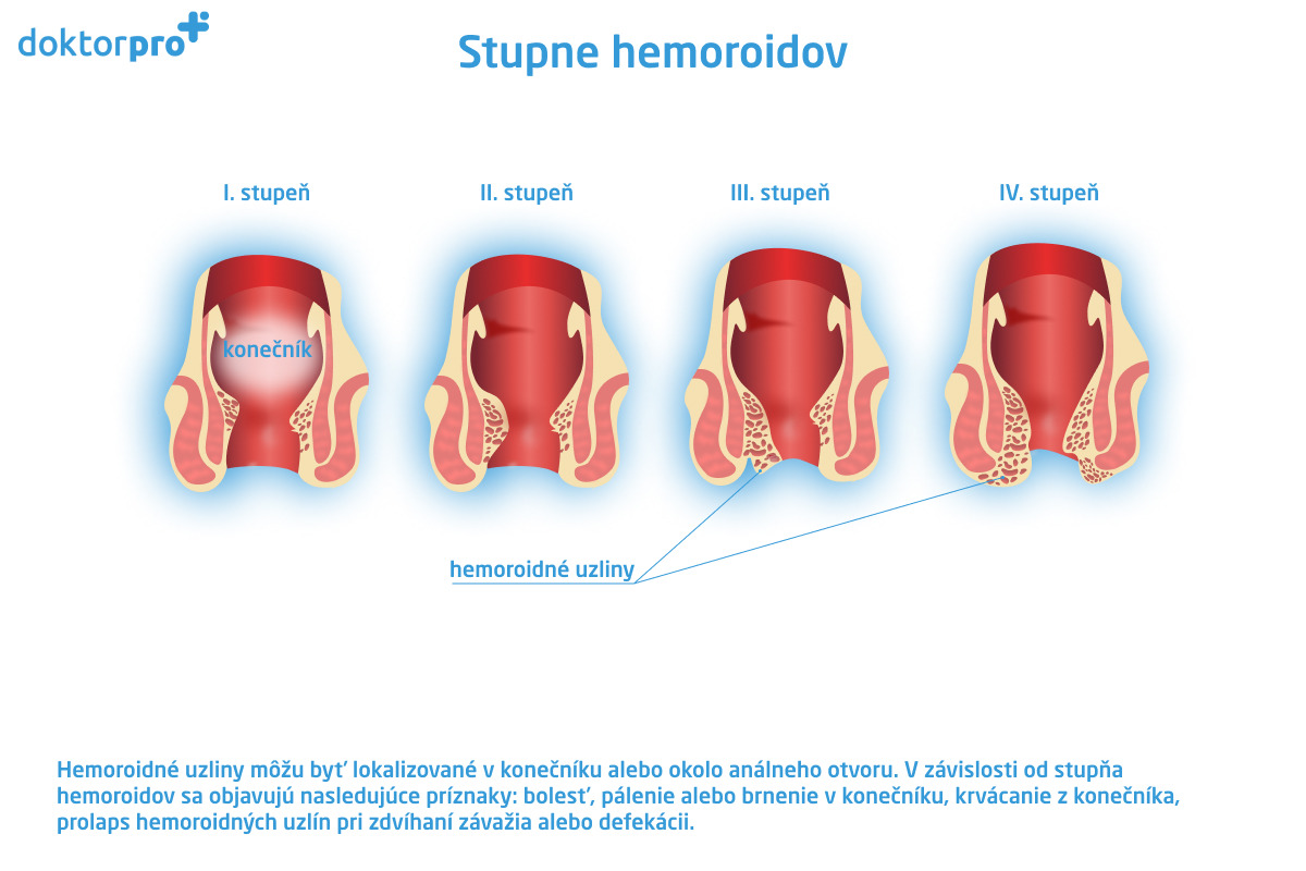 Stupne hemoroidov