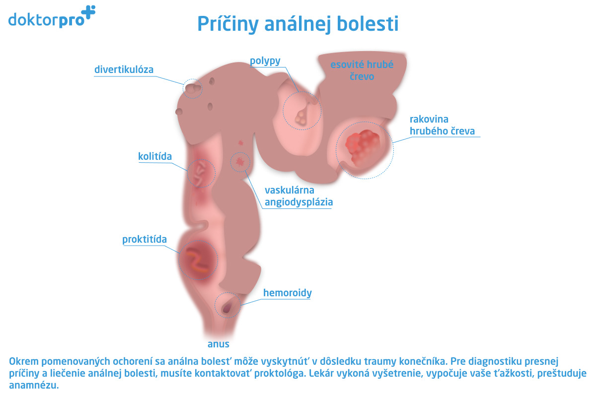 Príčiny análnej bolesti