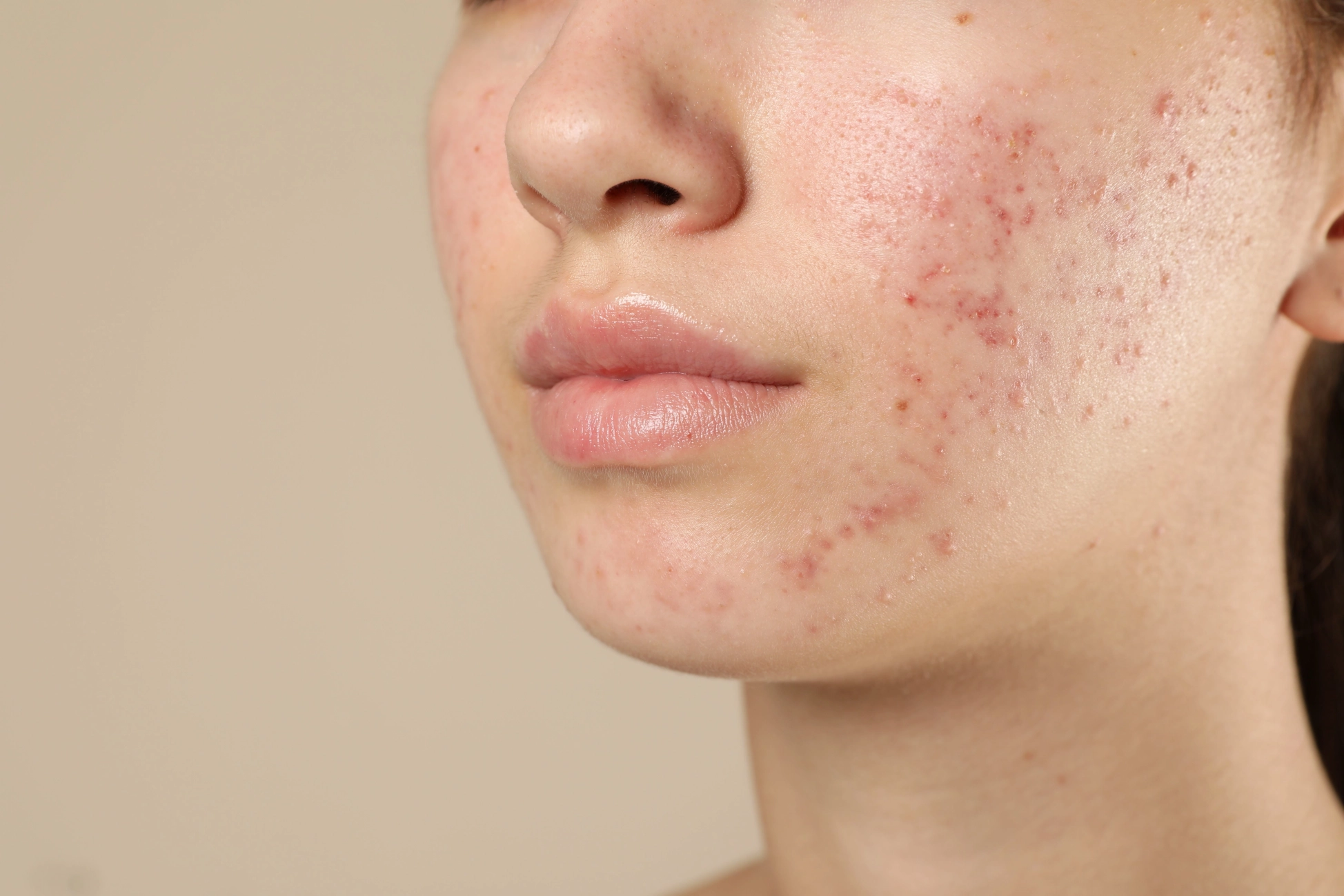 Akné: príčiny, príznaky, liečba a prevencia