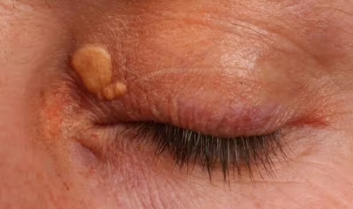 Voskové hrbole na očných viečkach pri ochorení pečene