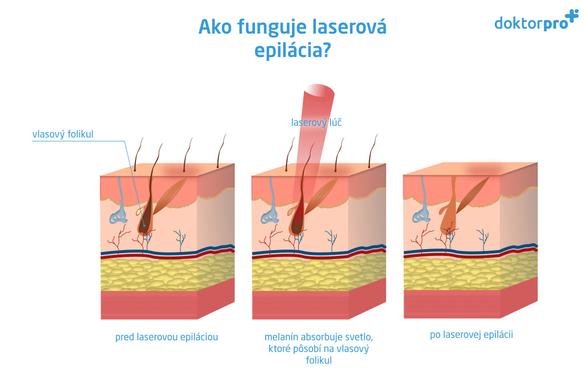 Ako funguje laserová epilácia?