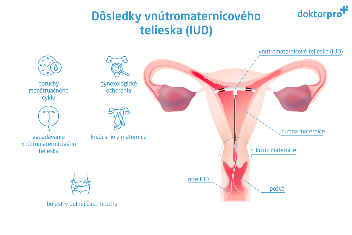 Dôsledky vnútromaternicového telieska (IUD)