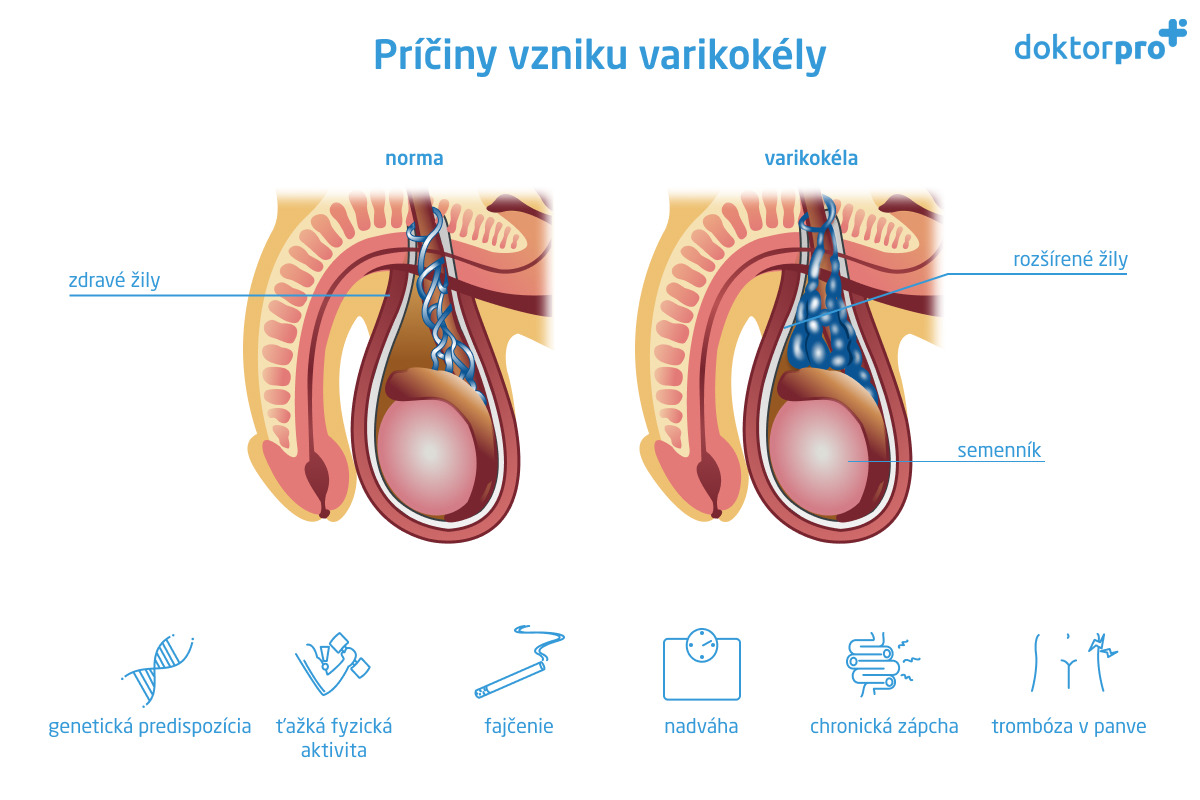 Príčiny vzniku varikokély