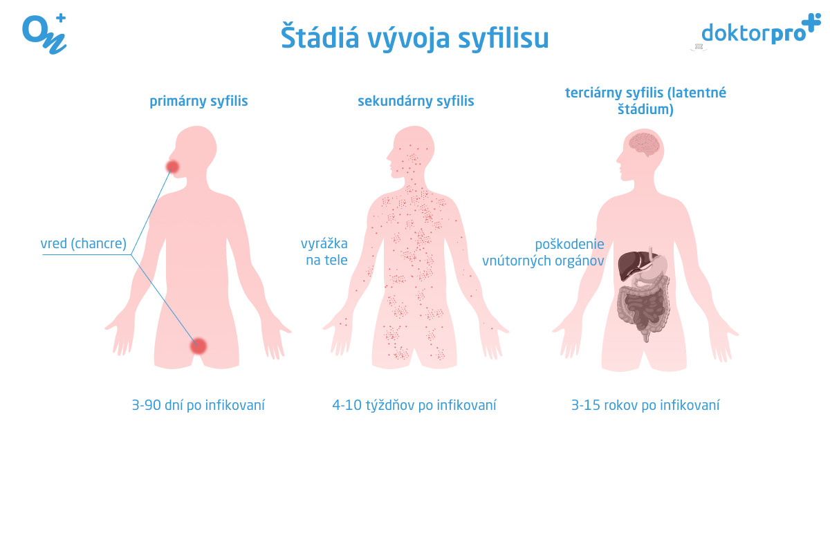 Štádiá vývoja syfilisu