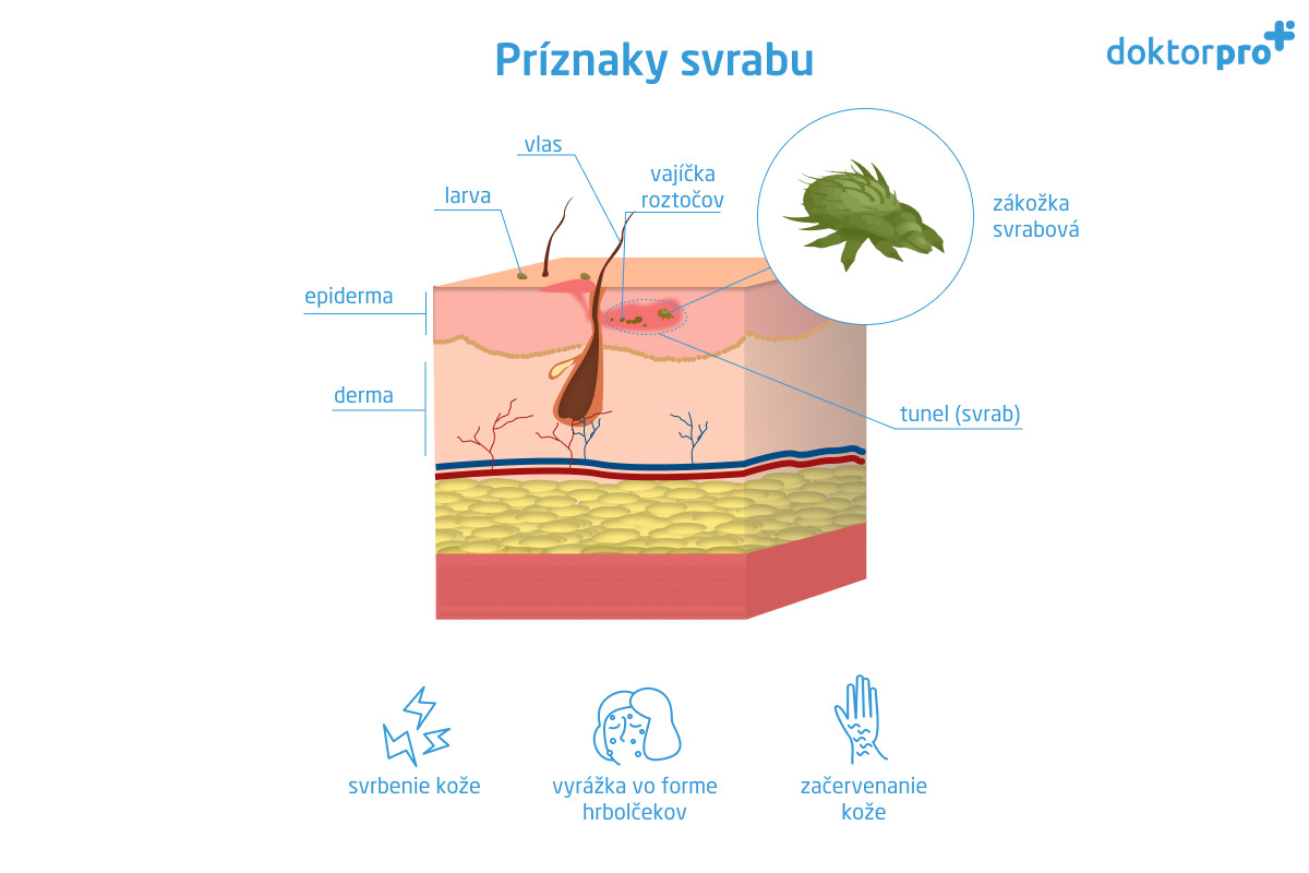 Príznaky svrabu