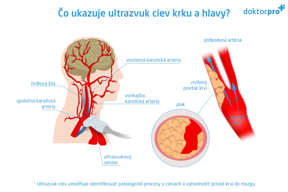 Čo ukazuje ultrazvuk ciev krku a hlavy?