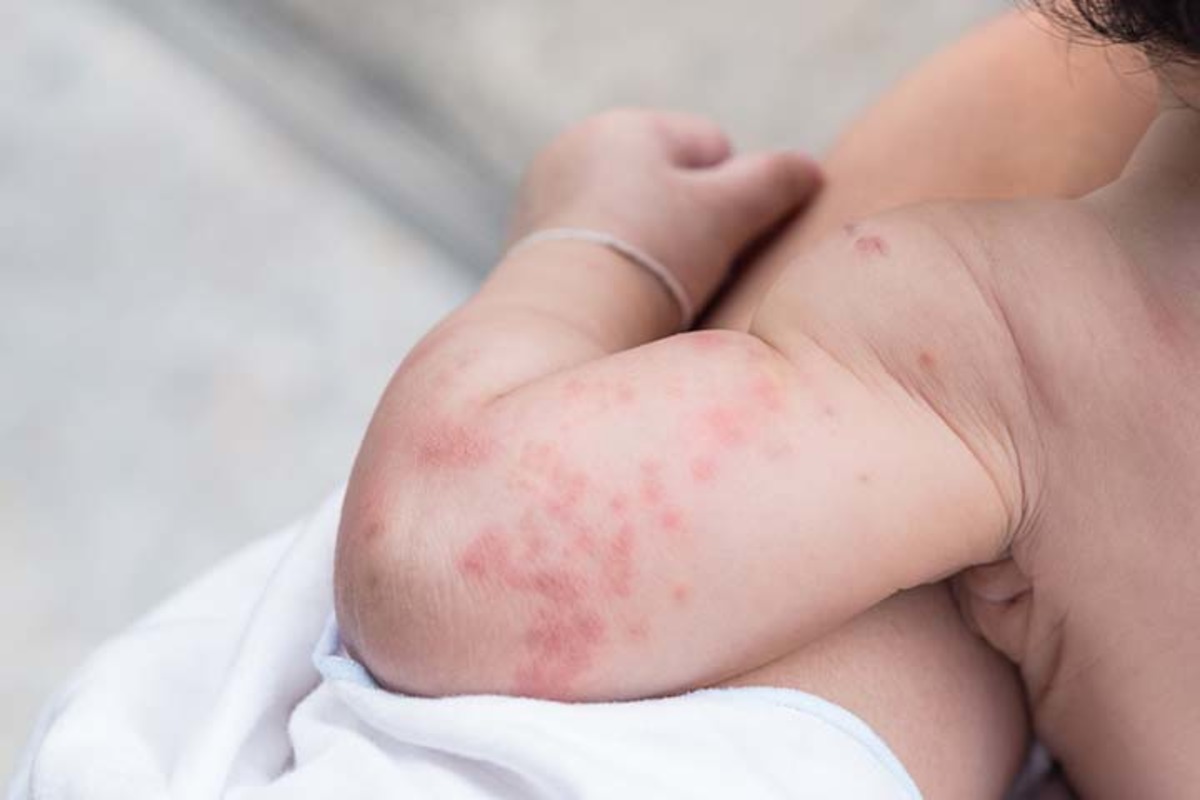 Alergia u dieťaťa na výrobky obsahujúce lepok