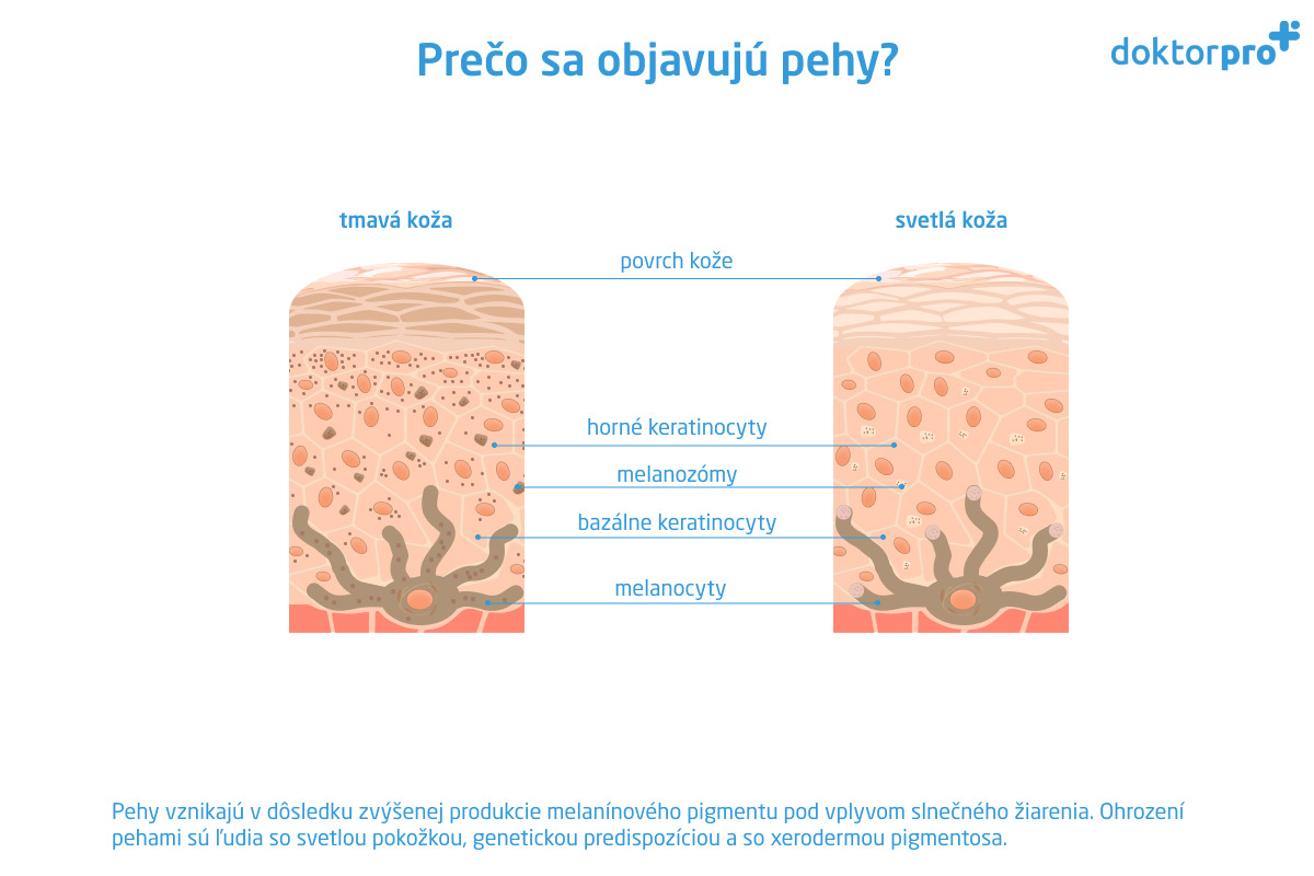 Prečo sa objavujú pehy?