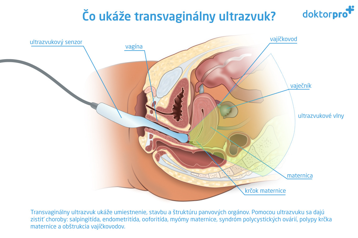 Čo ukáže transvaginálny ultrazvuk?