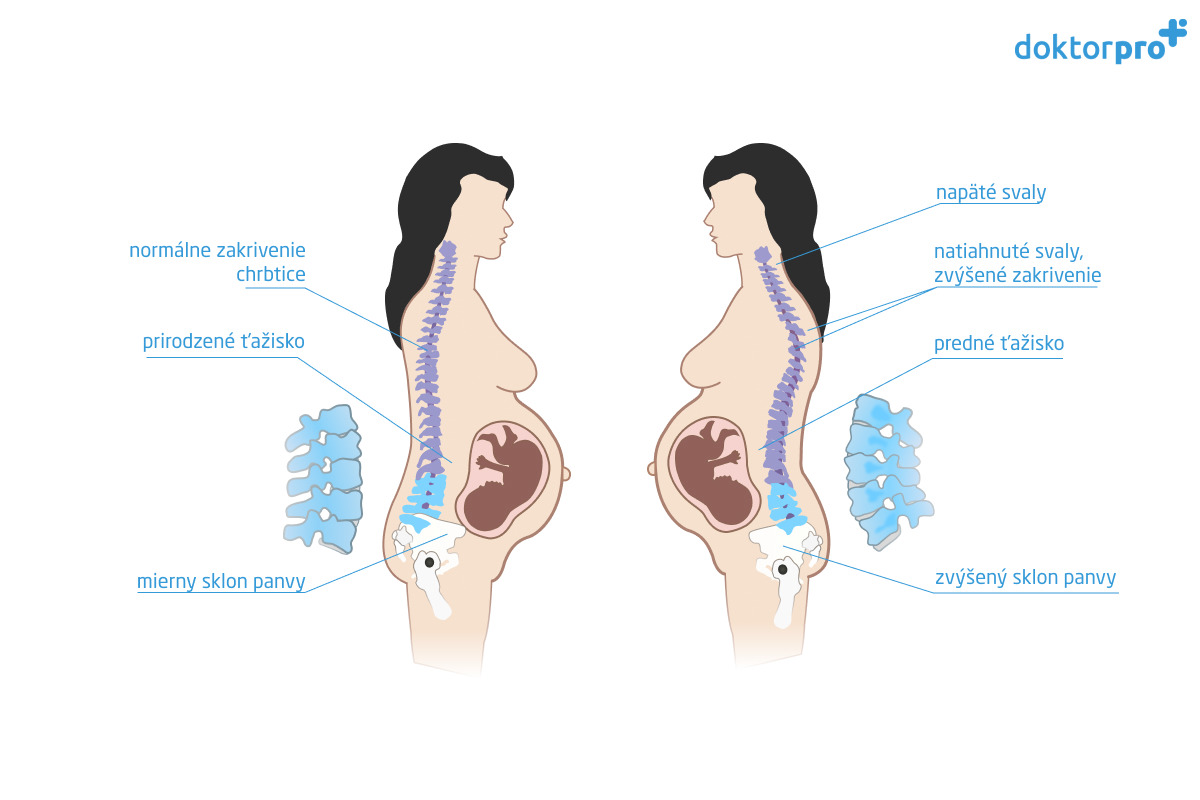 Bolesť chrbta v tehotenstve