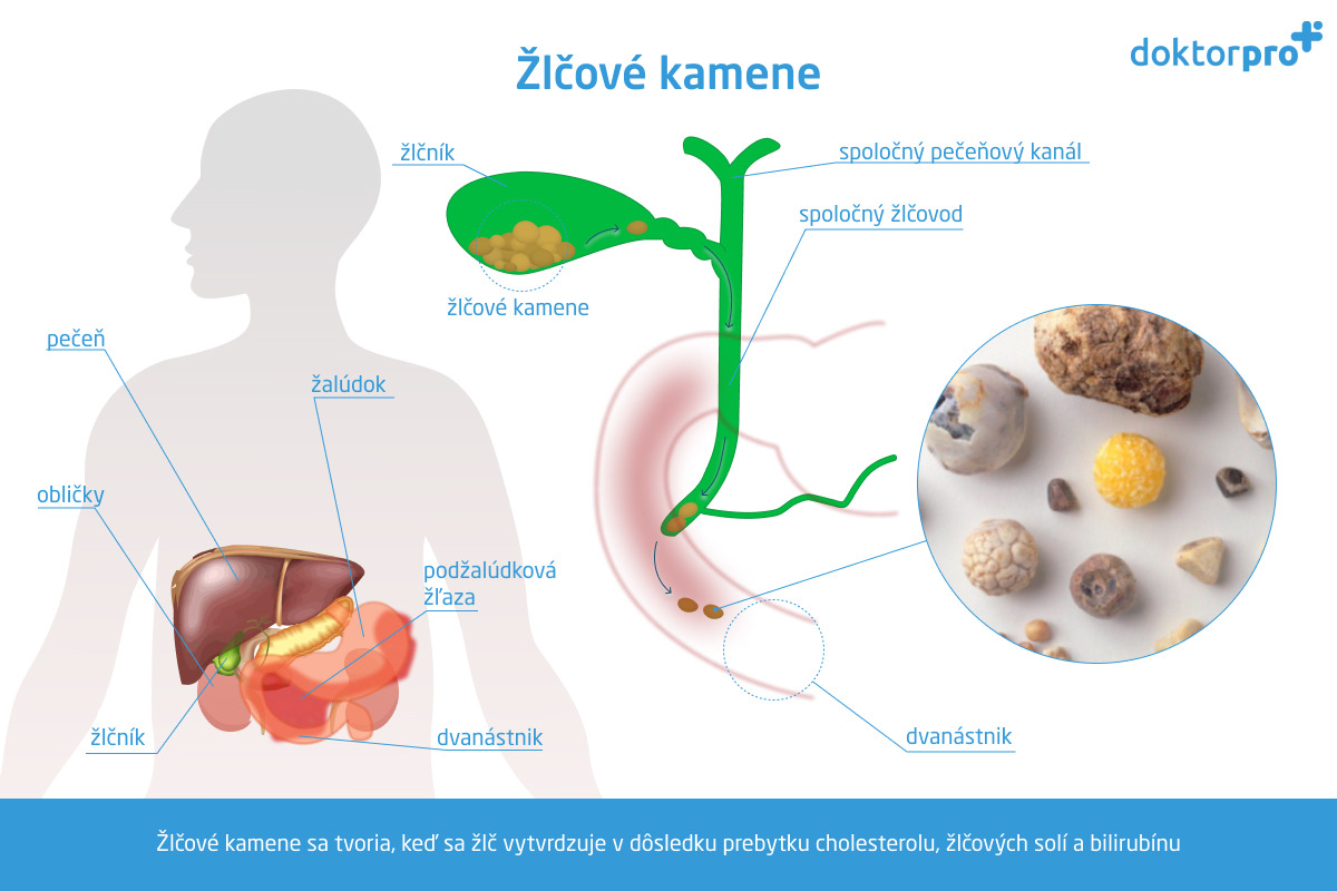 Žlčové kamene