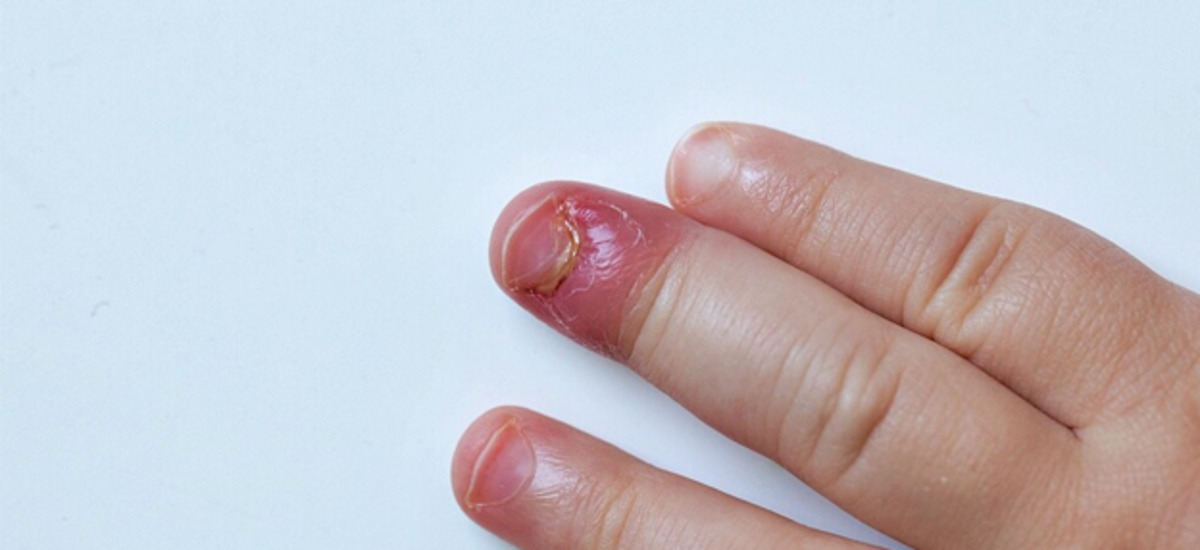 Panarícium u dieťaťa