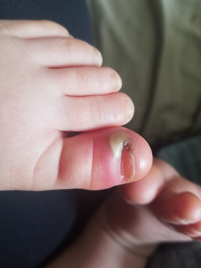 Panarícium na nohe dieťaťa