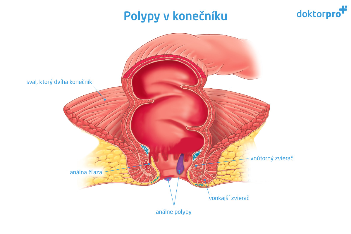 Polypy v konečníku