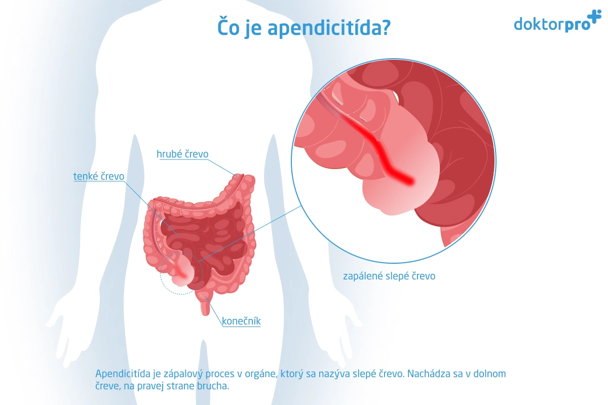 Čo je apendicitída?