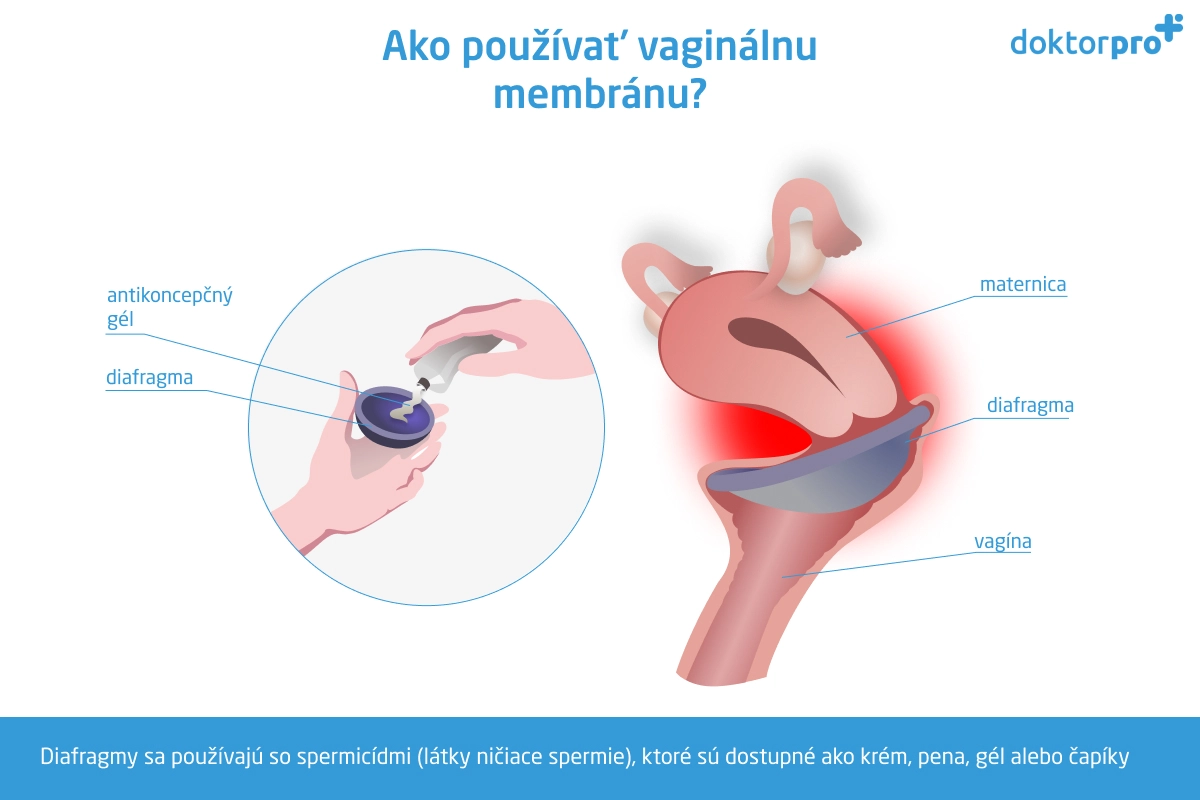 Ako používať vaginálnu membránu?