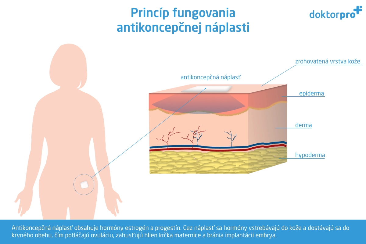 Princíp fungovania antikoncepčnej náplasti