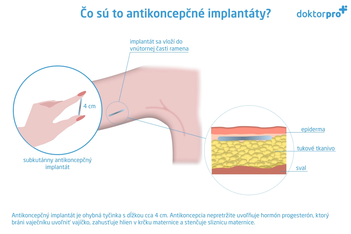 Čo sú to antikoncepčné implantáty?