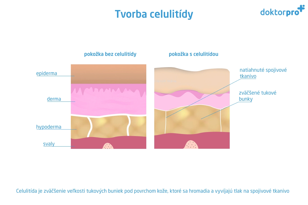 Tvorba celulitídy