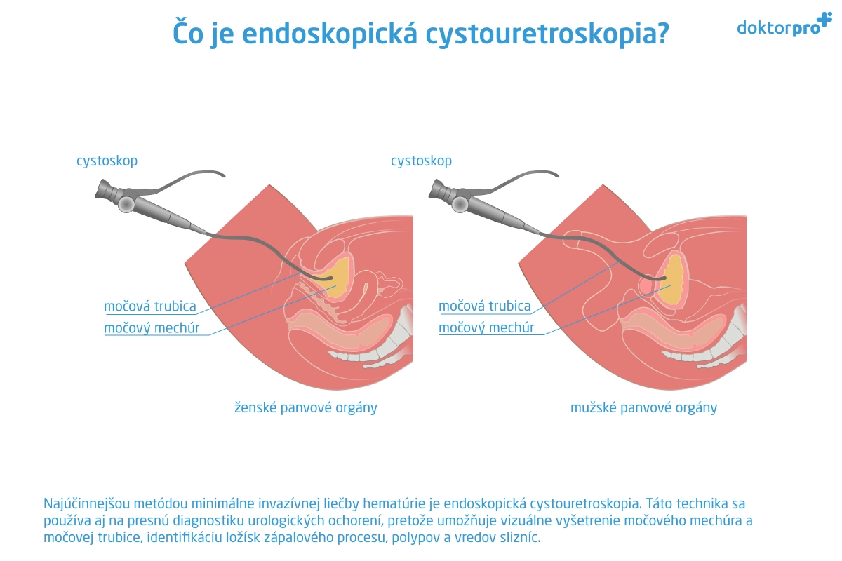 Čo je endoskopická cystouretroskopia?