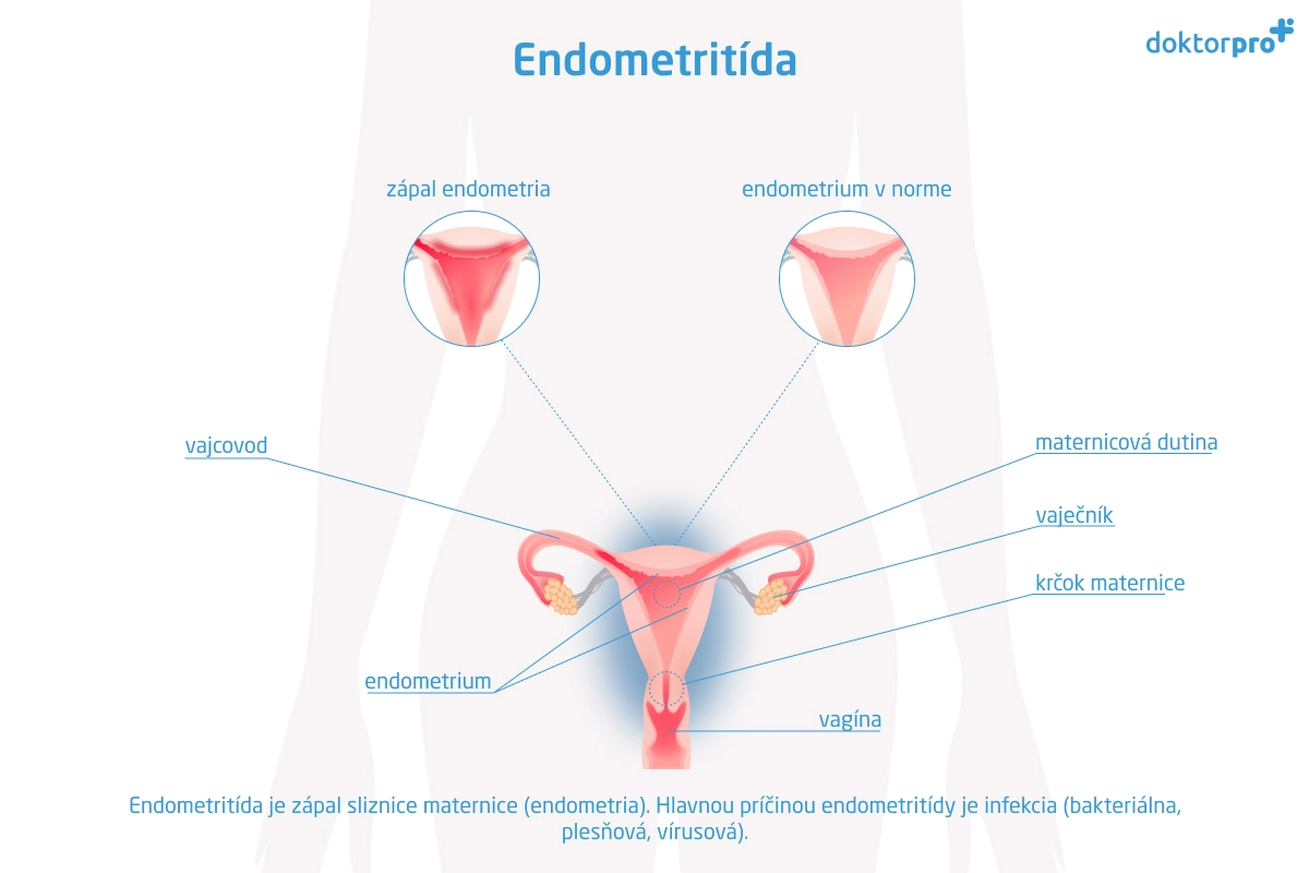 Endometritída