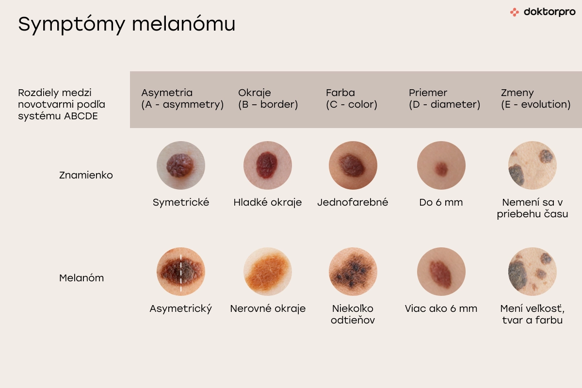 Symptómy melanómu