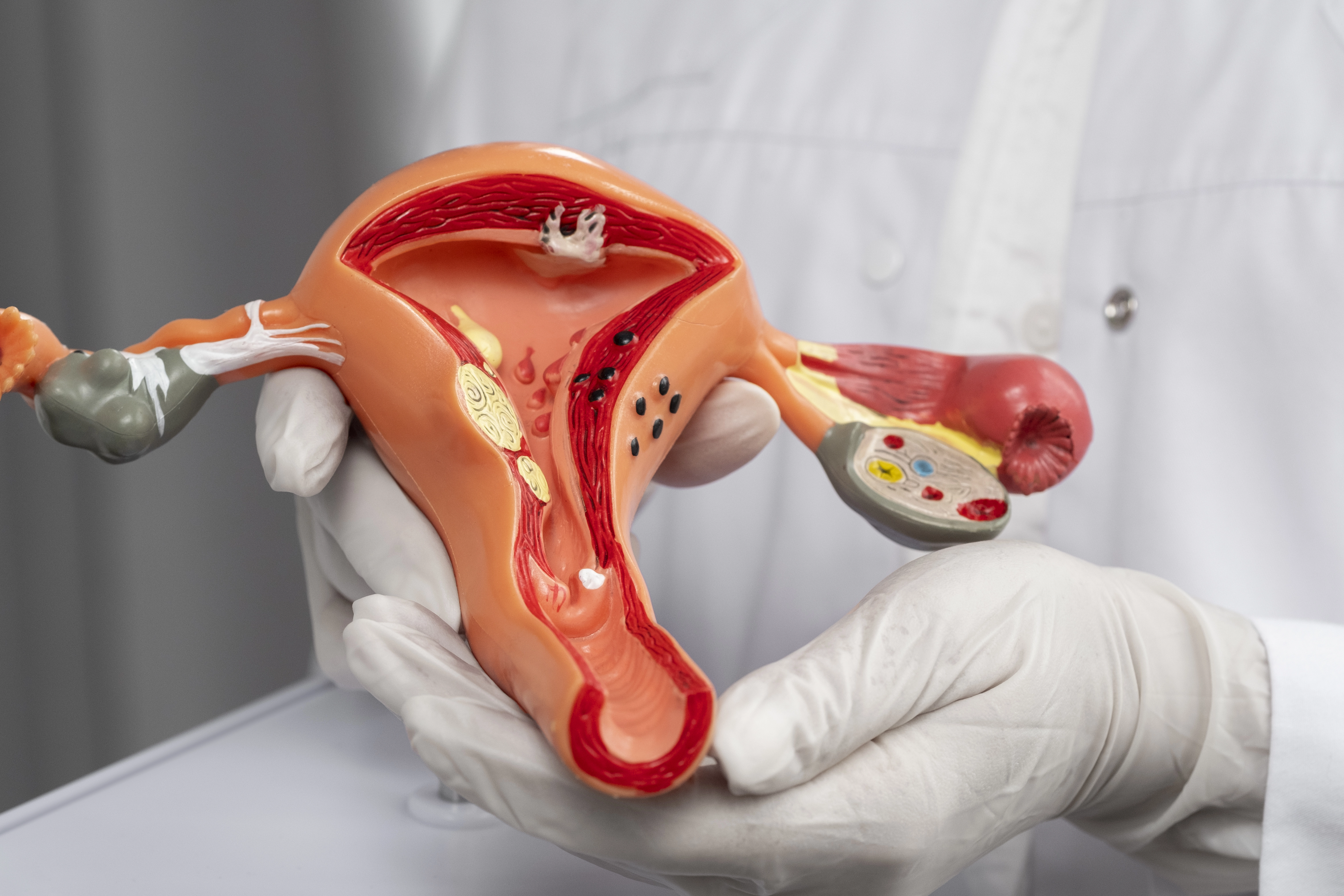 Žľazová hyperplázia endometria: príznaky, príčiny a metódy liečby