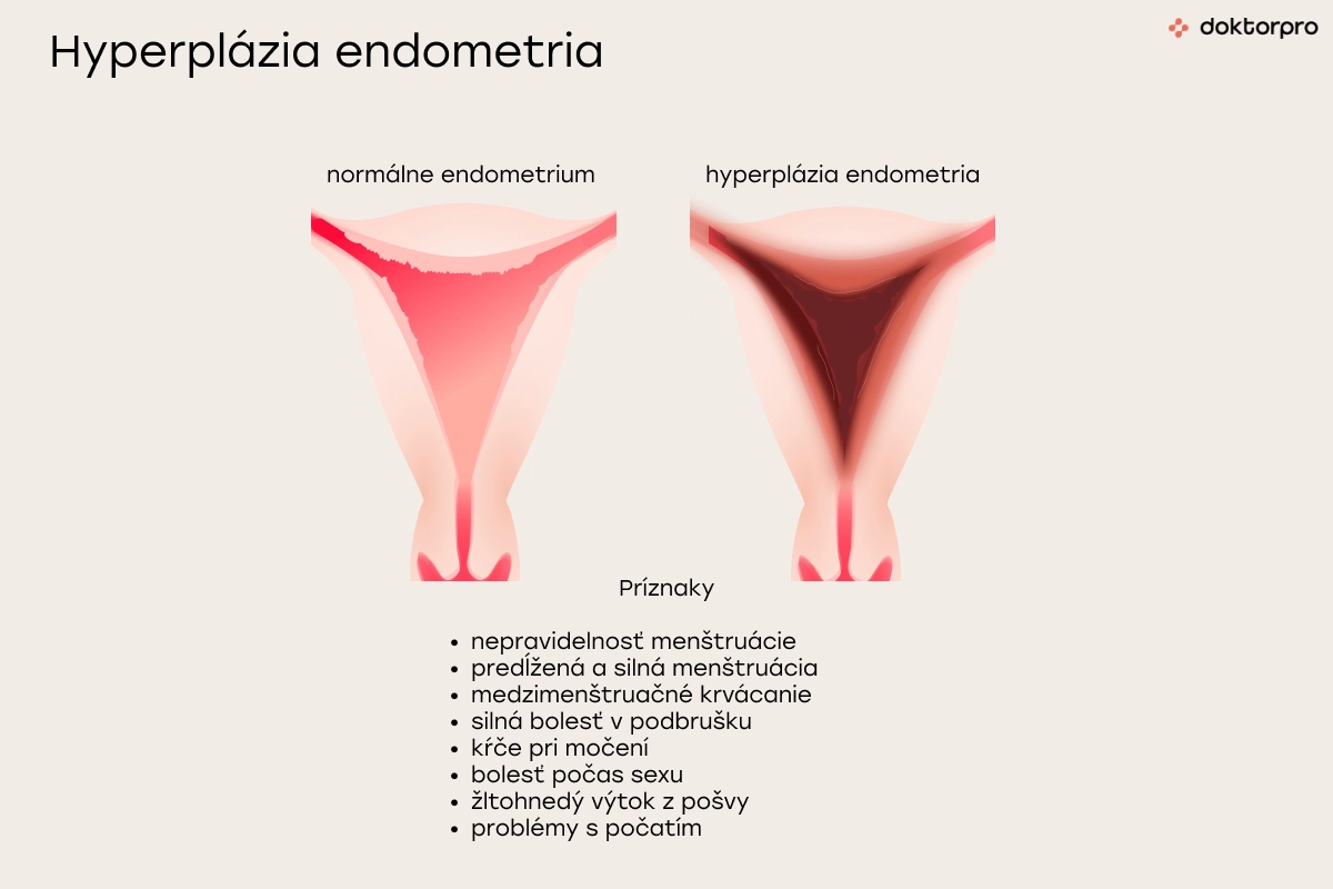 Hyperplázia endometria