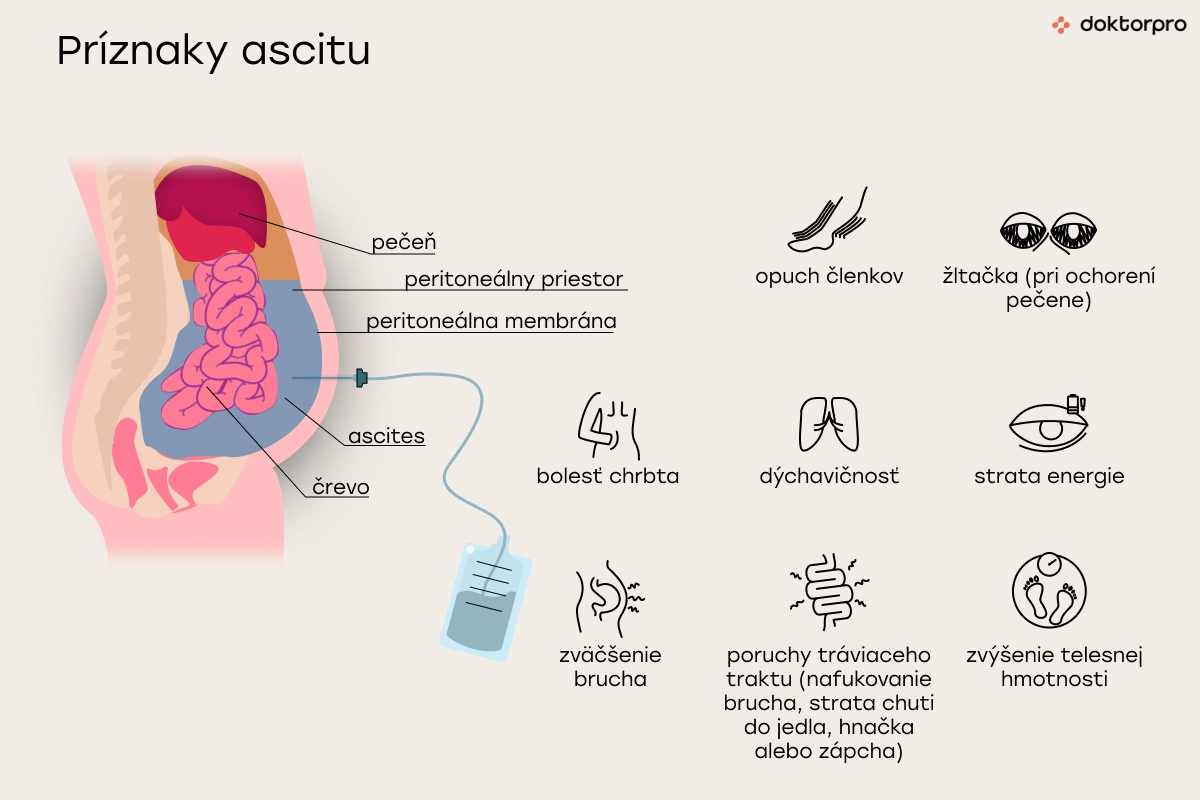 Príznaky ascitu