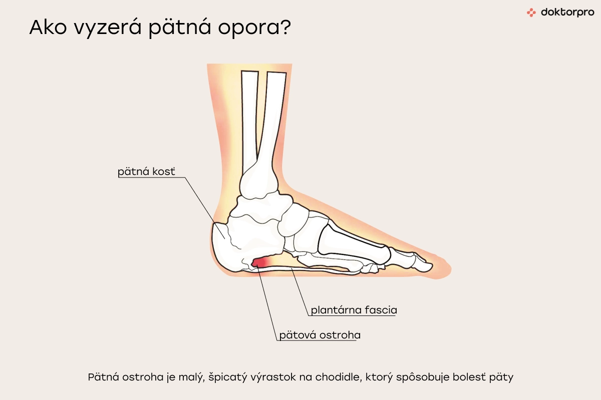 Ako vyzerá pätná opora?