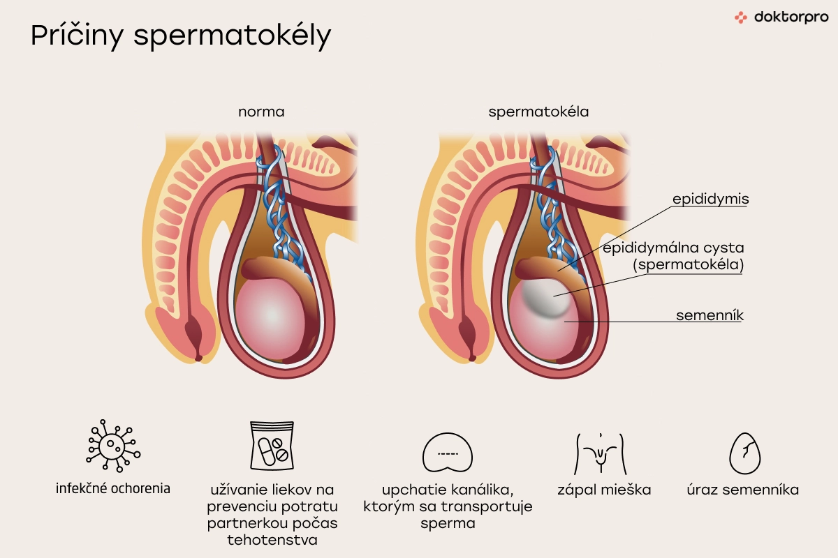 Príčiny spermatokély