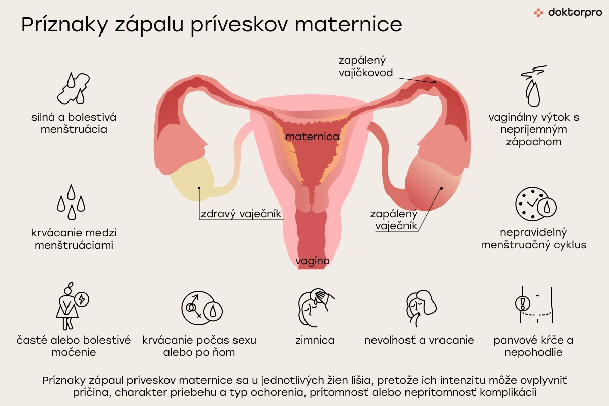 Príznaky zápalu príveskov maternice