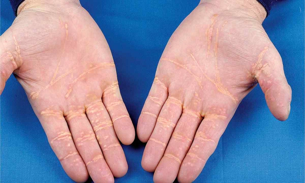 Keratodermia (hyperkeratóza dlaní a stupají)