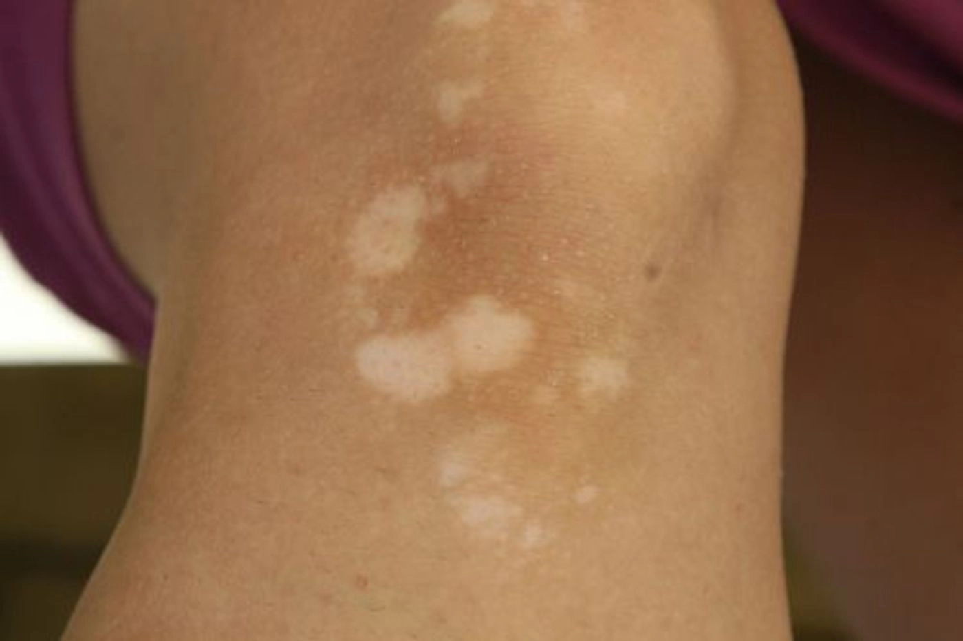 Ako vyzerá pityriasis (tinea) versicolor?