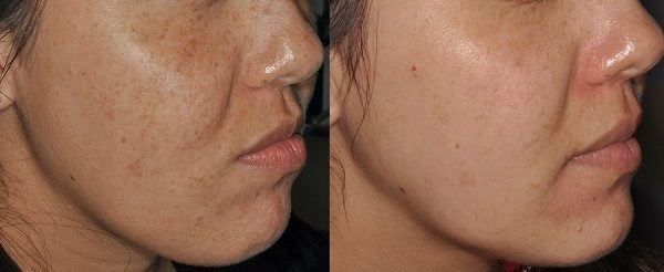 Príklad fotoomladenia tváre IPL Lumecca pred a po zákroku