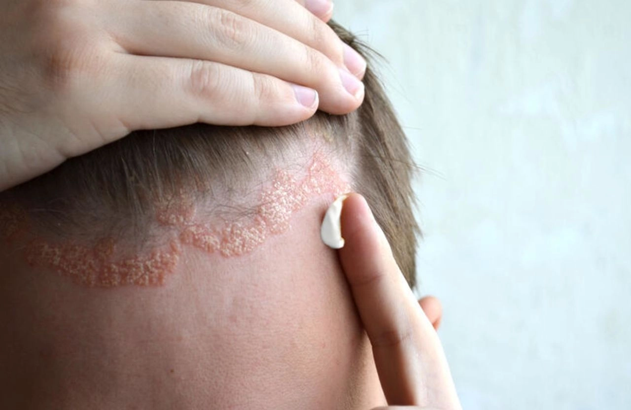 dôležitá liečba seboroickej dermatitídy