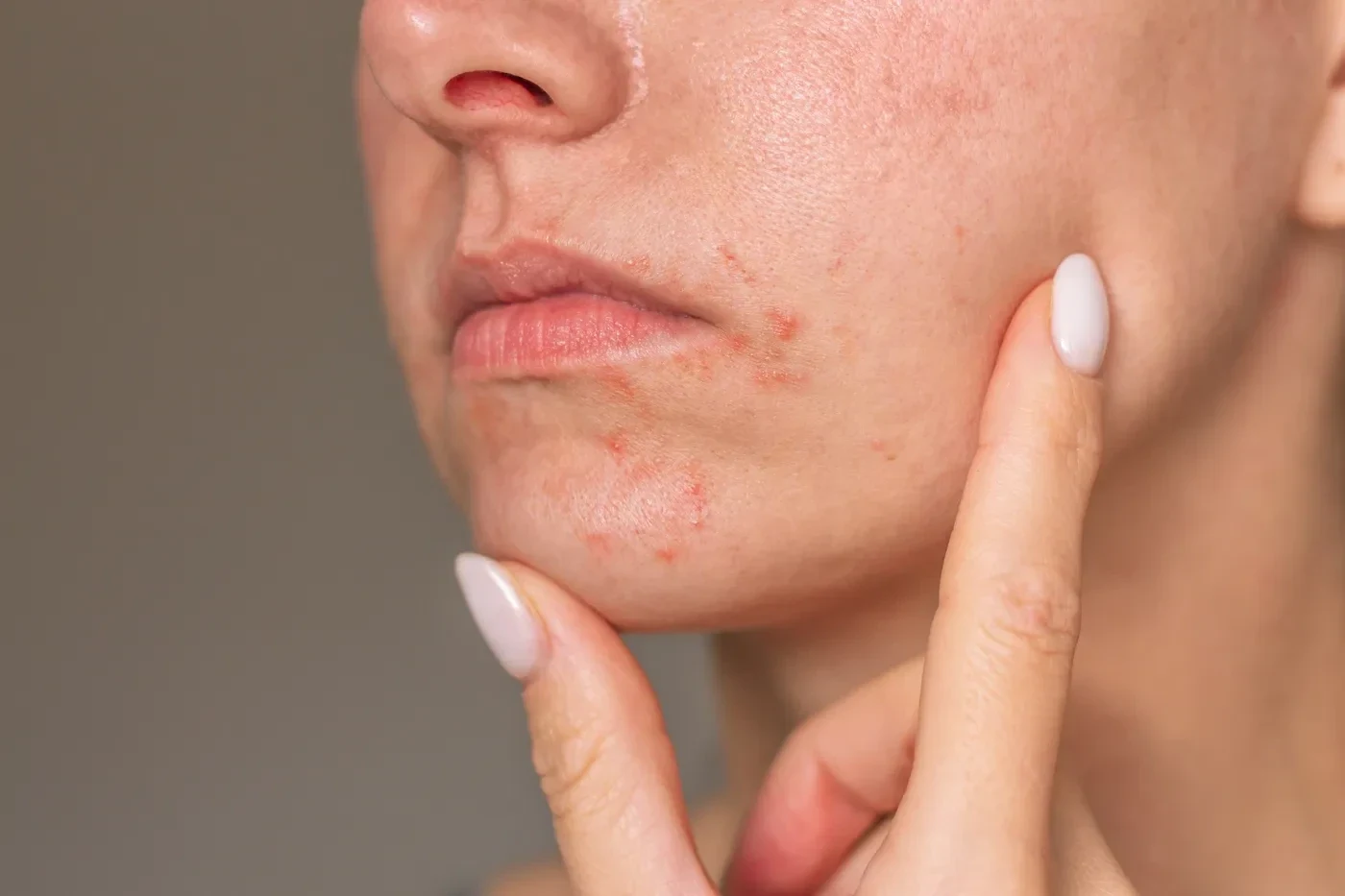 periorálna atopická dermatitída na tvári
