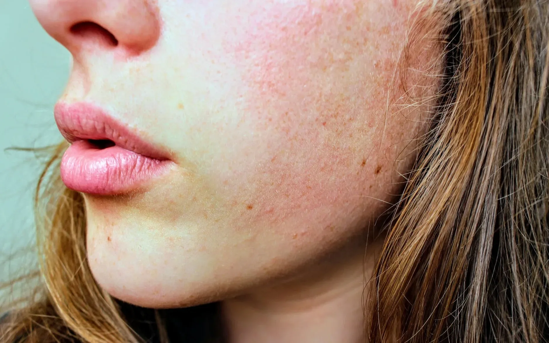 atopická dermatitída na tvári u dospelých