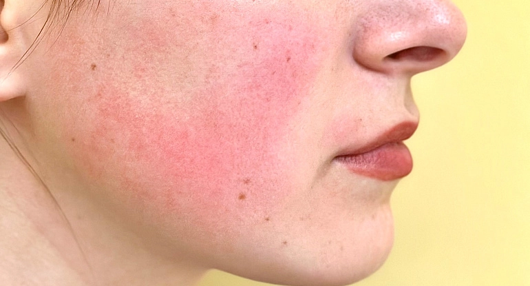 Erytematotelangieaktická (štádium I, počiatočná forma) rosacea