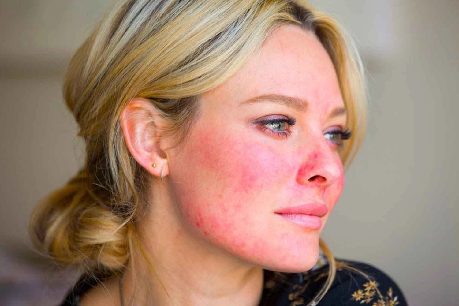 Papulopustulárna (zápalová forma II. stupňa) rosacea