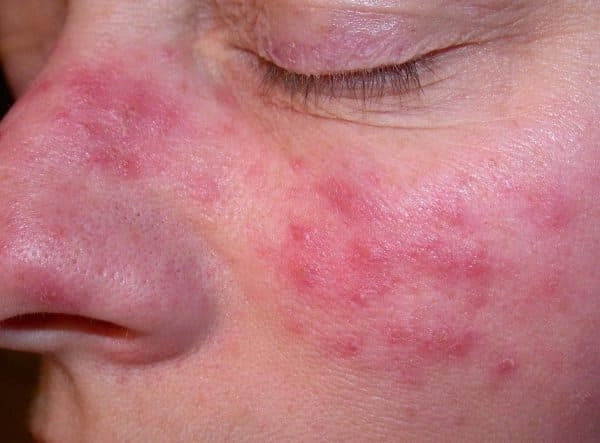 Fymatózna (štádium III, hypertrofická forma) rosacea