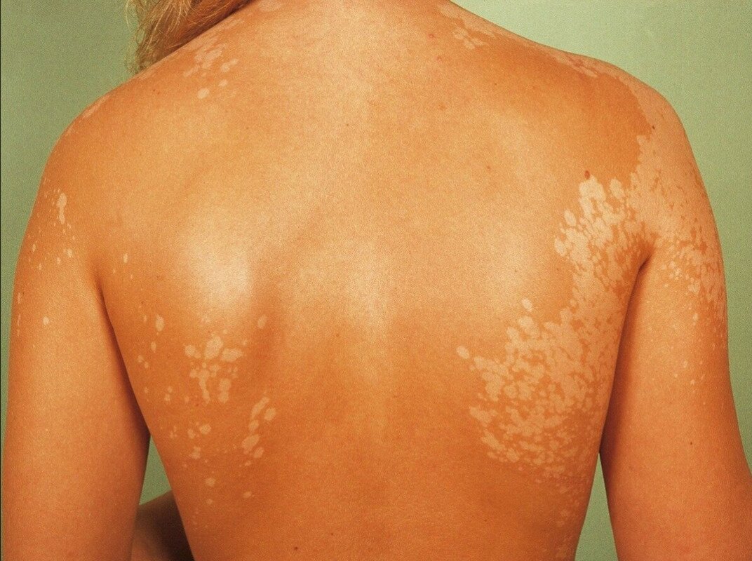 tinea versicolor na chrbte