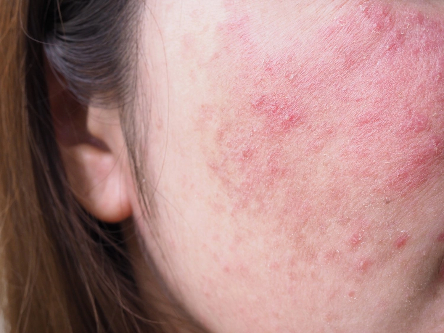 mierna rosacea dospelých