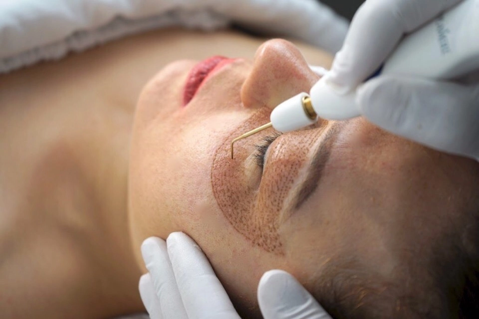 Proces nechirurgickej blefaroplastiky pomocou Plasma Skin