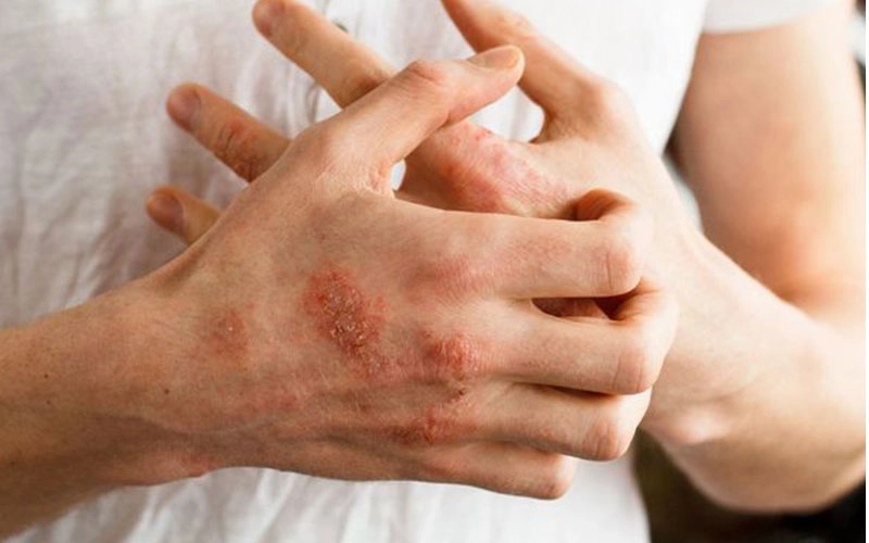 kontaktná dermatitída na rukách