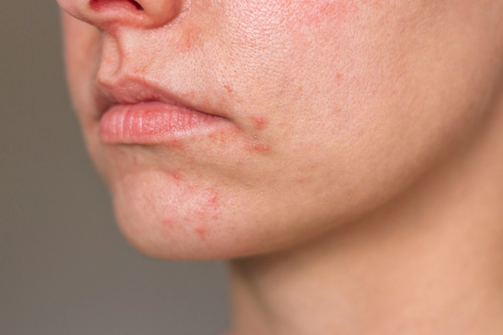 Periorálna dermatitída u dospelého