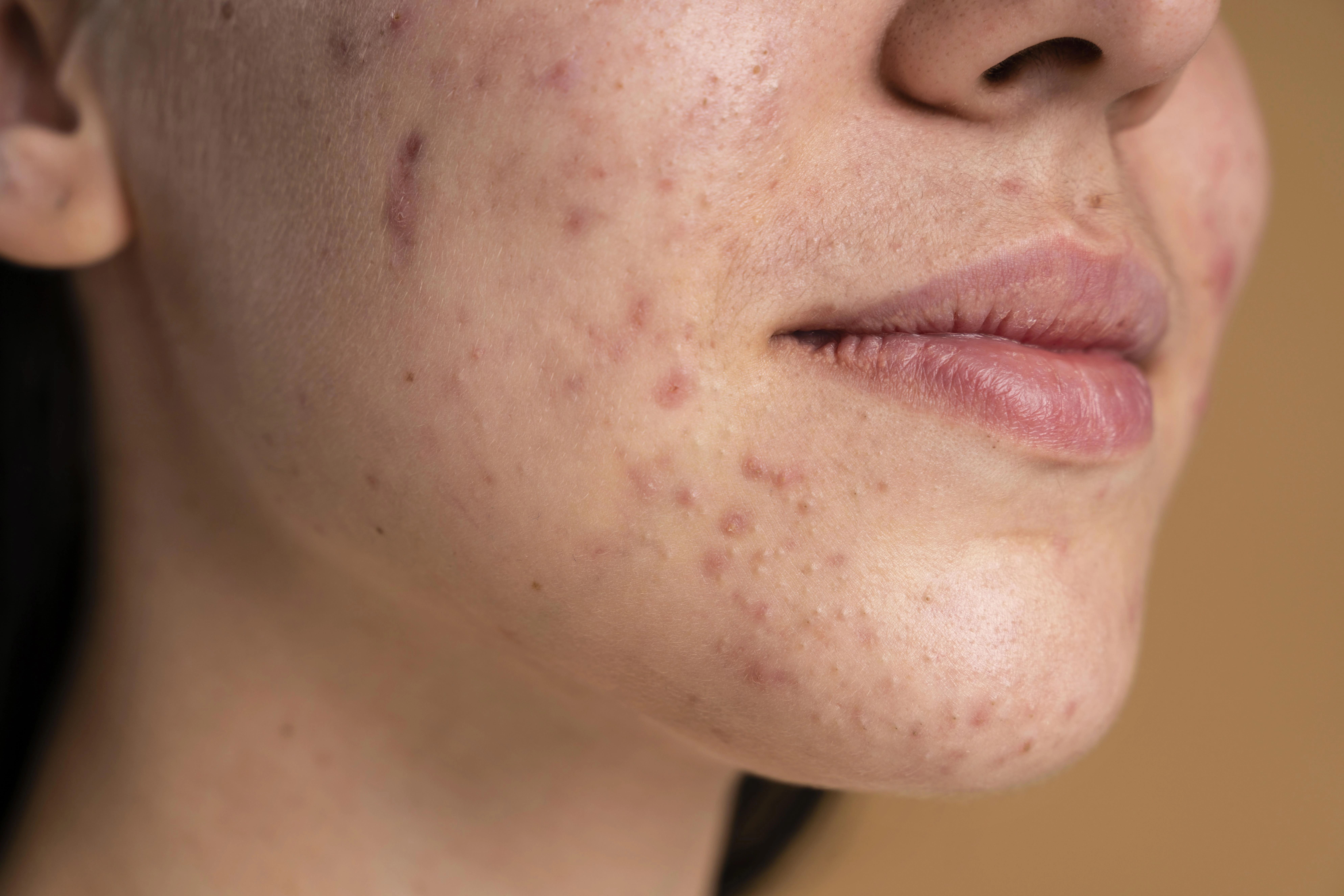 Periorálna dermatitída u dospelých: prečo sa objavuje a ako sa jej zbaviť?