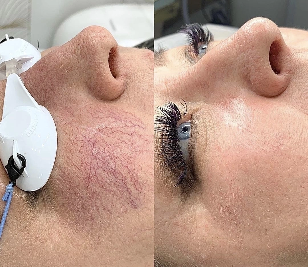 Odstránenie hemangiómov pomocou IPL laserovej technológie LUMECCA
